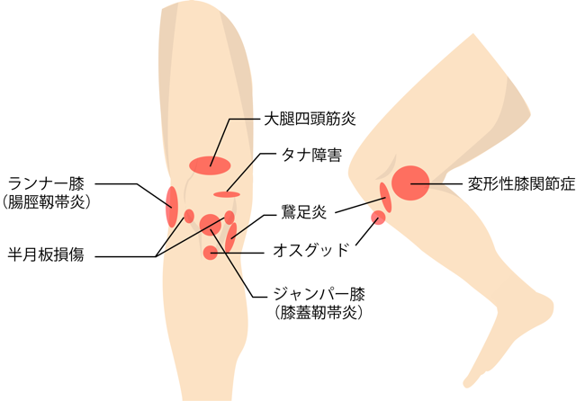 膝の症状