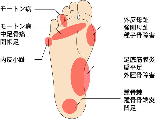 足裏の症状
